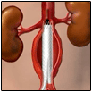 Endograft Animation